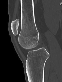 Chronic Patella Dislocation 2